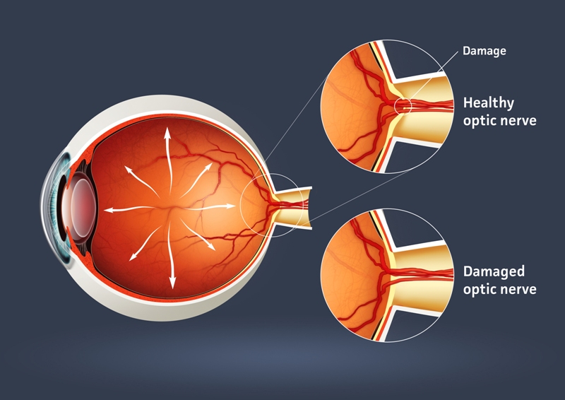 Glaucoma Can Easily Be Treated If Caught Early Enough